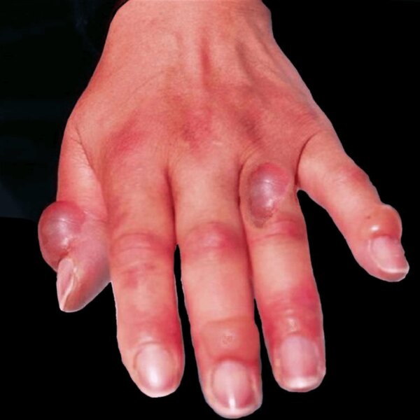 Second-degree frostbite: blisters with clear fluid and reduced sensitivity in the affected area. Photo: https://commons.wikimedia.org/wiki/File:Hand_frostbite.jpg